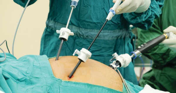 Laparoscopic Cholecystectomy